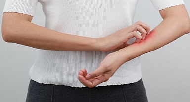 Soğuk Hava Ve Rüzgar egzamayı Tetikliyor! 